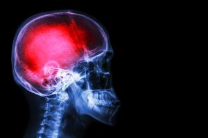 northbrook brain injury lawyer